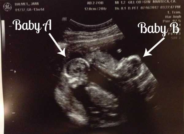 Снимок УЗИ при многоплодной беременности