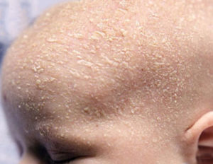 Шелушение кожи головы у новорождённого и взрослого ребенка