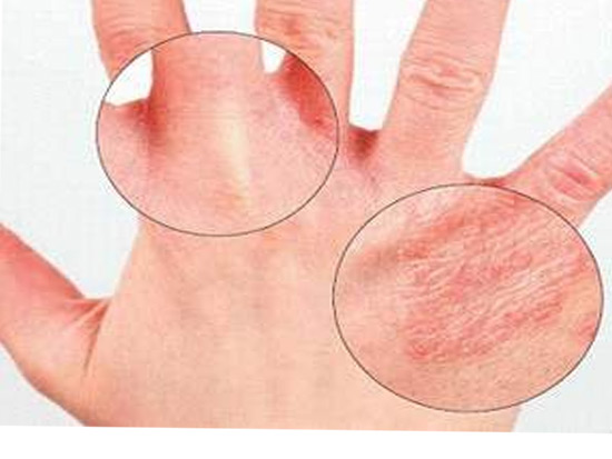 Аллергия на моющие средства на руках лечение