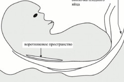 Комбинированный скрининг на синдром Дауна