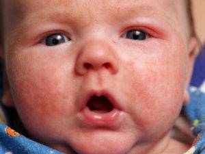 Аллергия у младенца - экзема