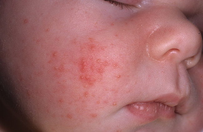Аллергия на лице новорождённого