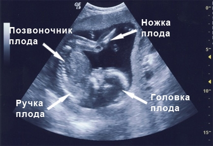 Фото УЗИ 19 неделя беременности