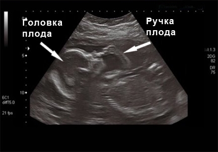 Фото УЗИ 21 неделя беременности