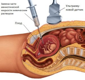 Солевой аборт
