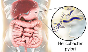 бактерии H. pylori в желудке как причина гастрита