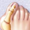 Косточка на большом пальце ноги: причины, симптомы и лечение в домашних условиях