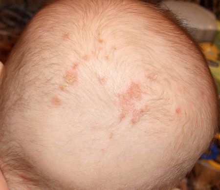 Себорейный дерматит-корочки на голове ребенка