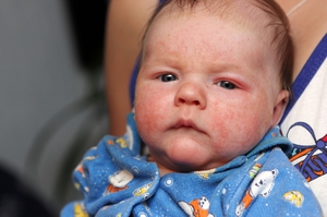 Аллергия у малыша может возникнуть по причинам добавления нового продукта в рацион.