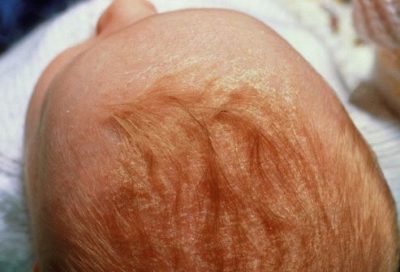 Воспаление кожи на голове у ребенка