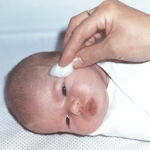 обработка глаз новорожденного