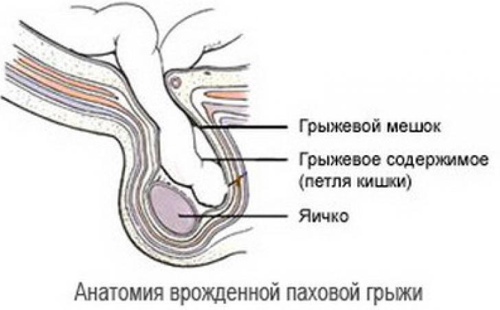 структура паховой грыжи