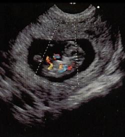 беременность первое УЗИ
