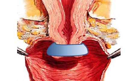 акушерский пессарий отзывы 