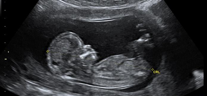 12 недель беременности фото плода
