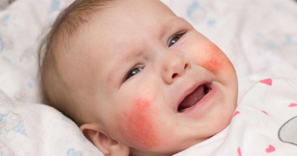 аллергия у младенца