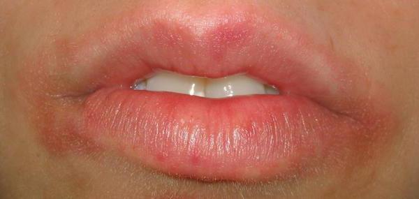 покраснение и шелушение кожи вокруг рта