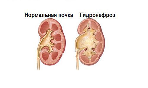 Нормальная почка и гидронефроз