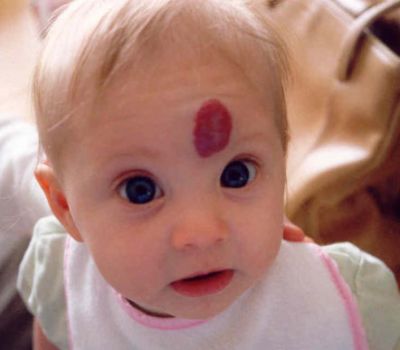 Гемангиома у ребенка на лице