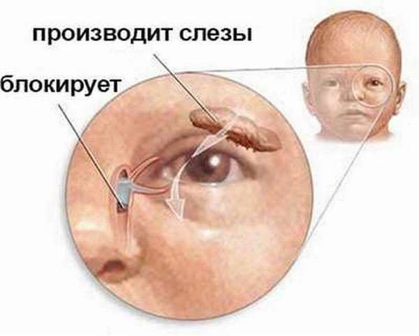 Массаж носослезного канала у новорожденных помогает избавиться от небольшой закупорки и освободить ее для оттока слез.