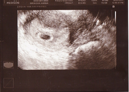 Как выглядит беременность на узи 2 недели фото