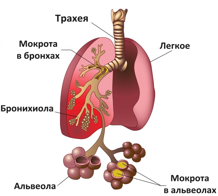 Золотистый стафилококк у грудничка – что это, причины возникновения, признаки и как лечить