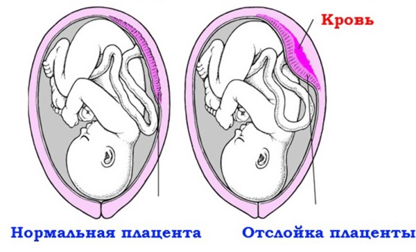 Норма гемоглобина у детей по возрасту, Таблица. Причины низкого гемоглобина, питание, препараты