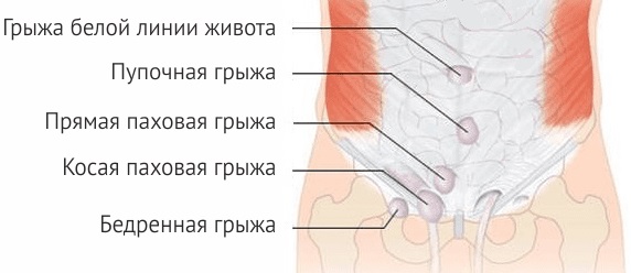 Паховая грыжа у детей мальчиков, девочек. Фото, как выглядит, симптомы, лечение, удаление