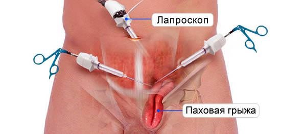 Паховая грыжа у детей мальчиков, девочек. Фото, как выглядит, симптомы, лечение, удаление