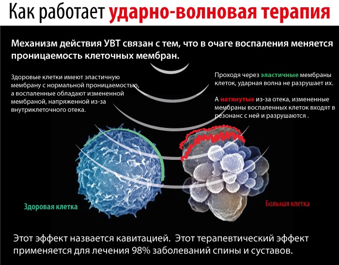 Грудной остеохондроз у женщин. Признаки, ощущение. Лечение, препараты, упражнения