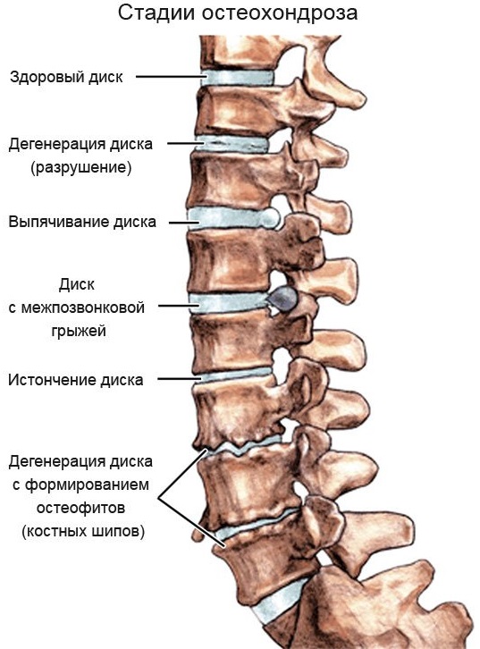 Грудной остеохондроз у женщин. Признаки, ощущение. Лечение, препараты, упражнения