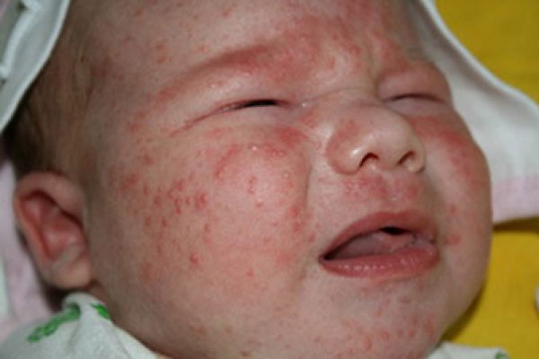 сыпь у новорожденного на лице