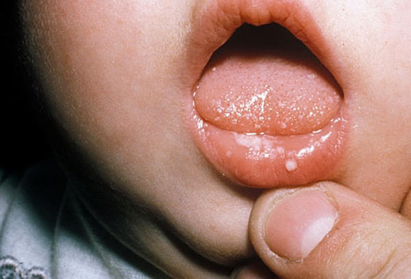 молочница во рту у ребенка