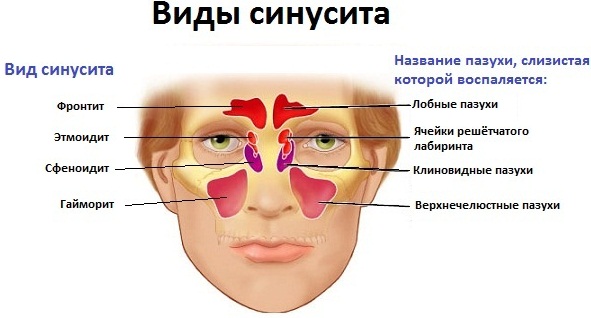 Увеличенные гланды у ребенка, но горло не болит. Фото, лечение, без операции