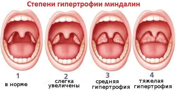 Увеличенные гланды у ребенка, но горло не болит. Фото, лечение, без операции