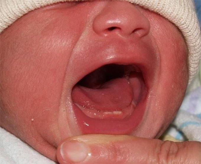 При прорезывании зубов ребенок испытывает дискомфорт