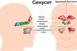 Симптоматика синусита