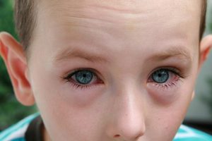 Описание аллергических реакций глаз у детей