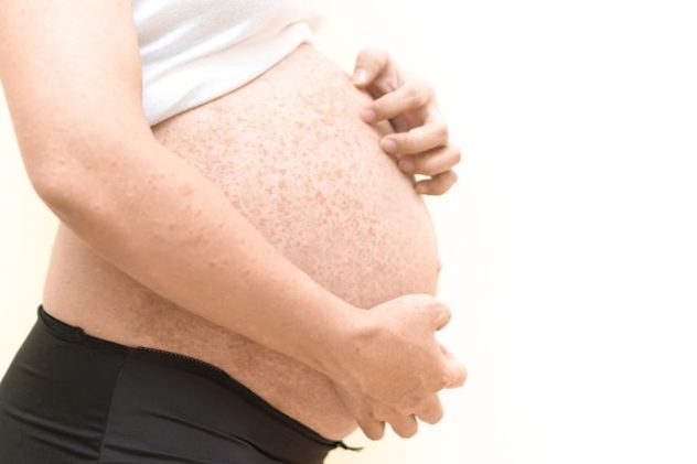 зуд кожи живота у беременных может возникать из-за аллергии