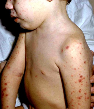 менингококковая инфекция, у детей, менингит, Сыпь у детей