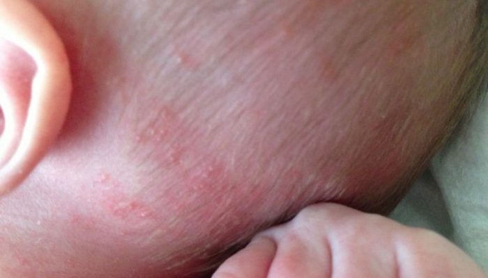 Что означают прыщики на лице, голове и теле у новорожденного? Мелкая белая, красная сыпь и гнойнички у грудничка