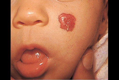 Доброкачественная опухоль гемангиома у ребёнка