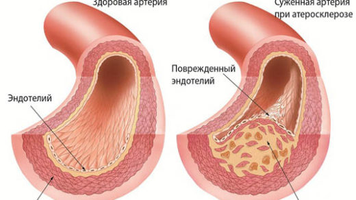 Атеросклероз сосудов головного мозга - симптомы и лечение 1