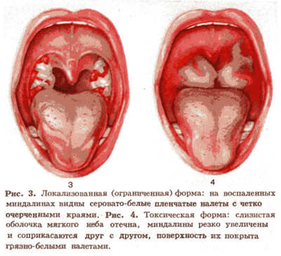 Фото локализованной и токсической форм дифтерии