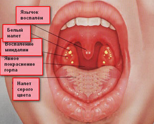 описание симптомов дифтерии на фото