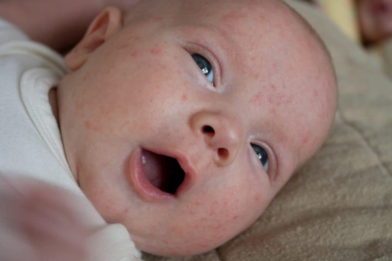 Сыпь на лице у новорожденного, что это и как лечить?
