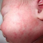 Токсическая эритема у новорожденных: причины, формы и лечение