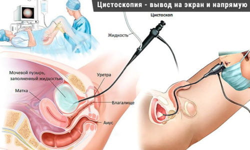 При цистоскопии, которая у детей до 10 лет выполняется с применением анестезии, с помощью эндоскопа можно рассмотреть поверхность слизистой