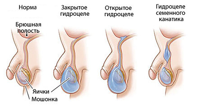 Водянка яичка у мальчиков – норма (слева) и виды патологий