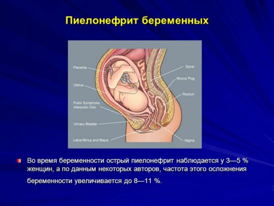 Пиелонефрит беременных